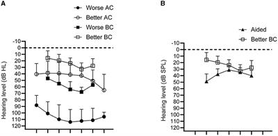 Pros and cons of a bone-conduction device implanted in the worse hearing ear of patients with asymmetric hearing loss